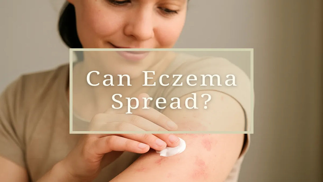 Can Eczema Spread? Debunking Myths and Understanding Patterns