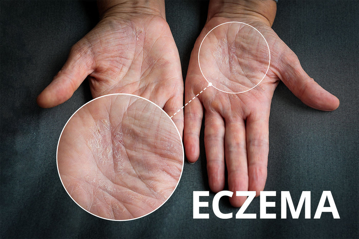 Drying Out Eczema Why You Should Avoid This “Remedy