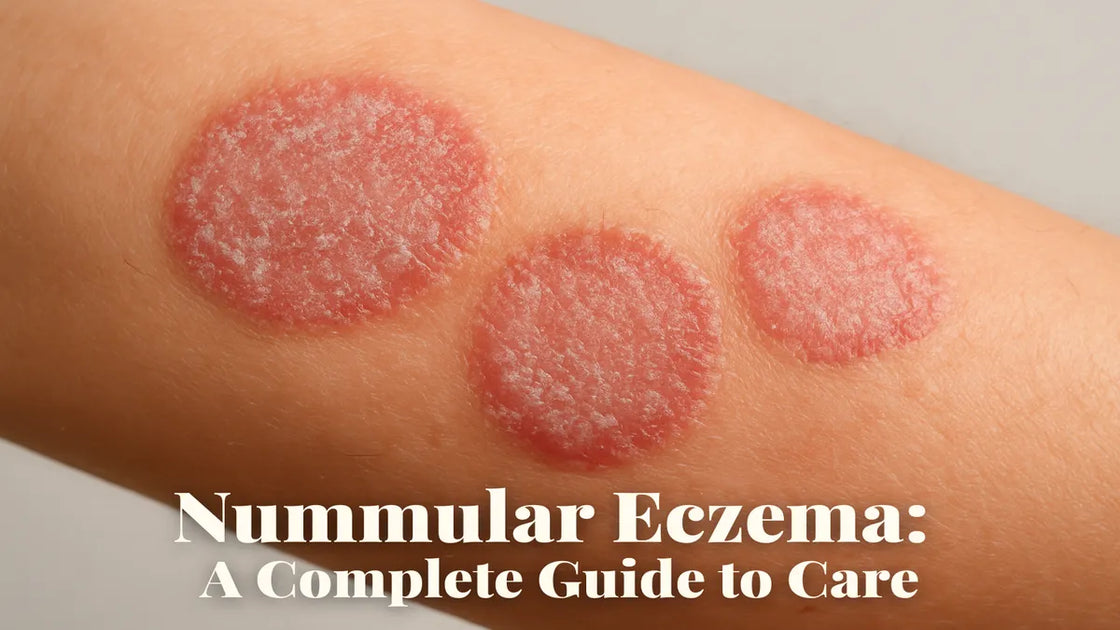 Nummular Eczema: Why Those Coin-Shaped Rashes Won't Heal