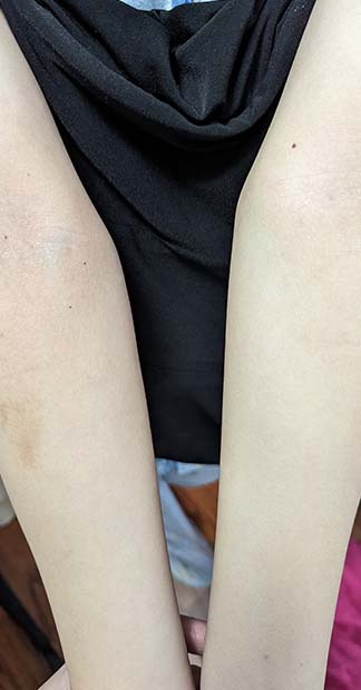 After treatment