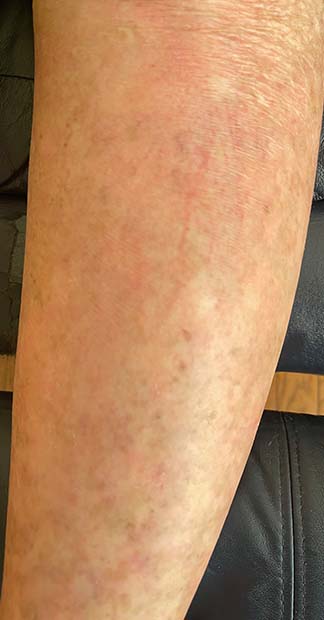 After treatment