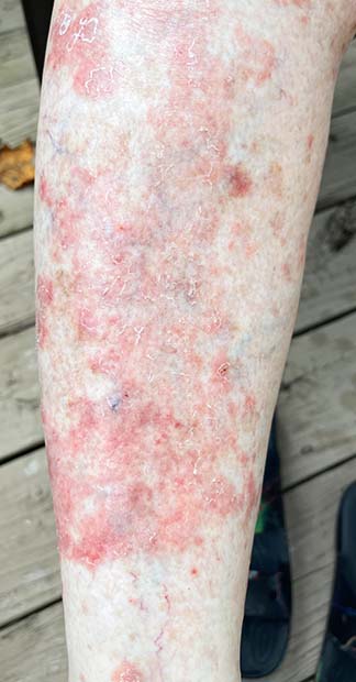 Before treatment