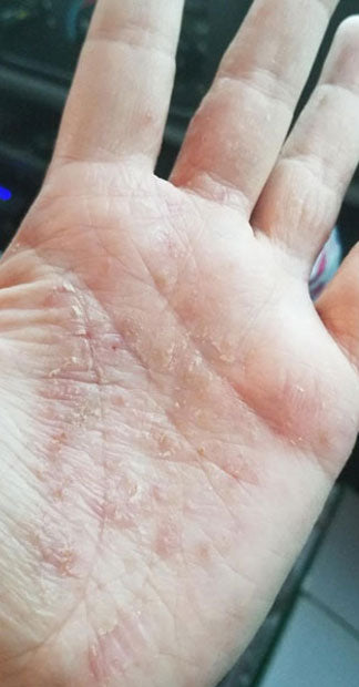 Before treatment
