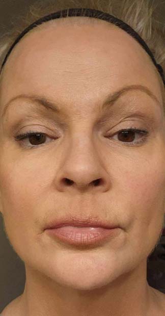 After treatment