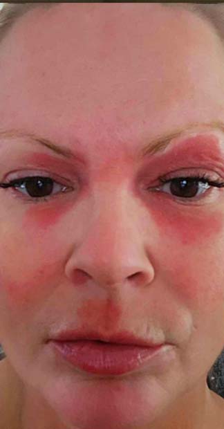 Before treatment
