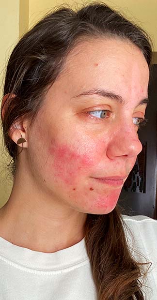 Before treatment