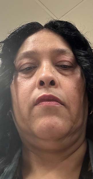 After treatment