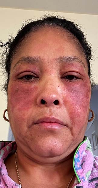 Before treatment