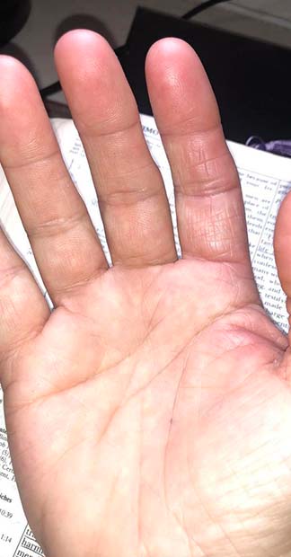 After treatment