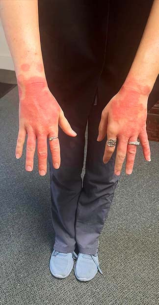 Before treatment