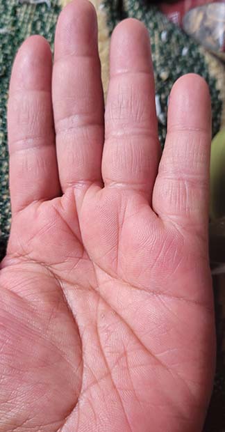 After treatment