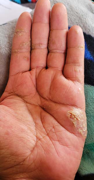 Before treatment