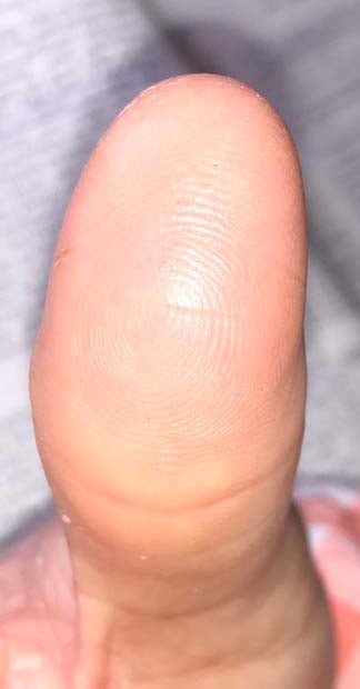 After treatment