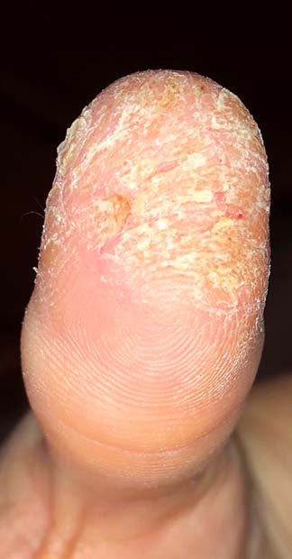 Before treatment
