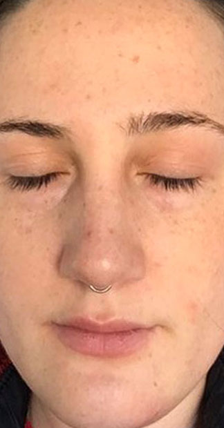 After treatment