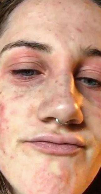 Before treatment