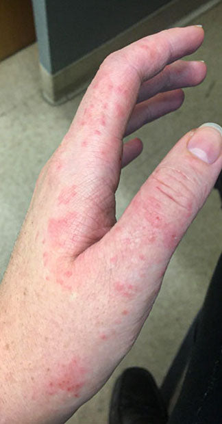 Before treatment