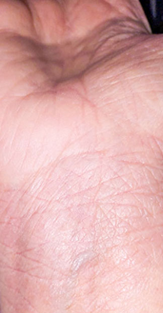 After treatment