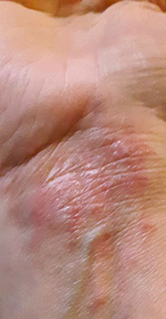 Before treatment