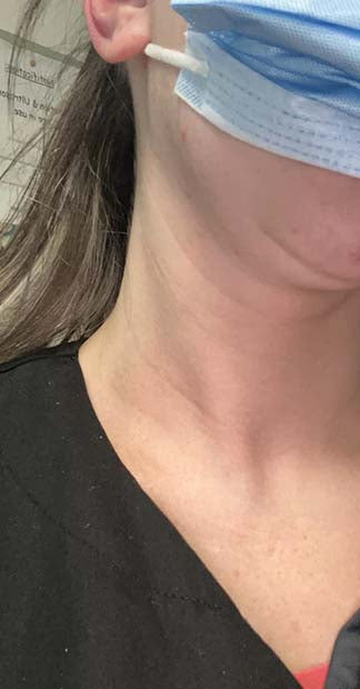 After treatment