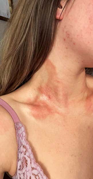 Before treatment