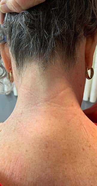 After treatment