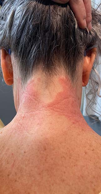 Before treatment
