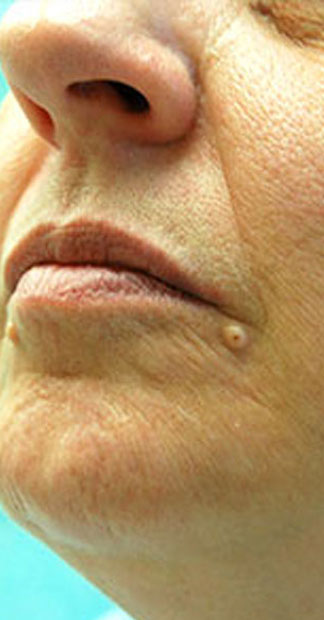 After treatment