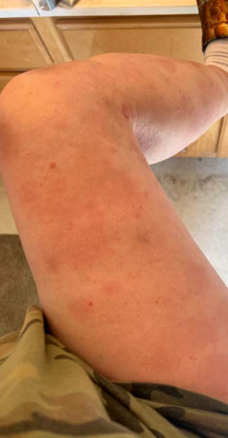 After treatment