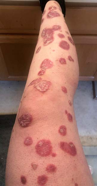 Before treatment