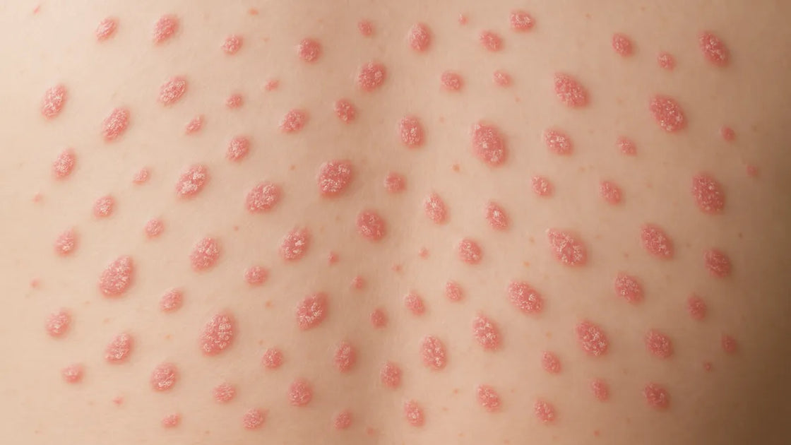Guttate Psoriasis: Treatments That Actually Work