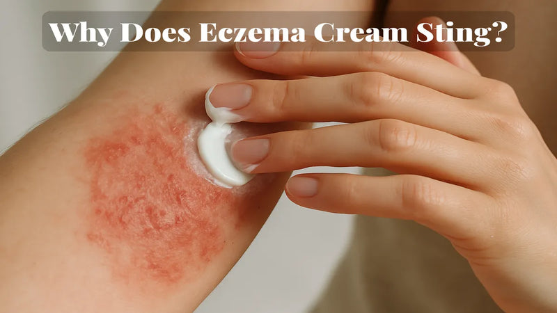 Why Does Eczema Cream Sting? Understanding the Burn
