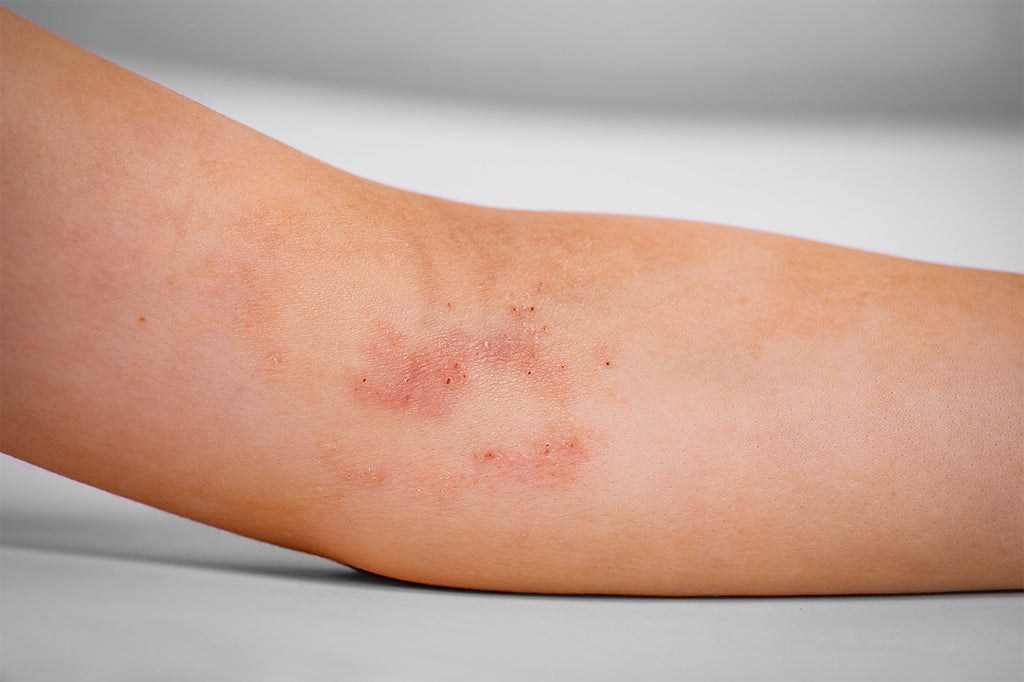 Atopic Dermatitis on the arm