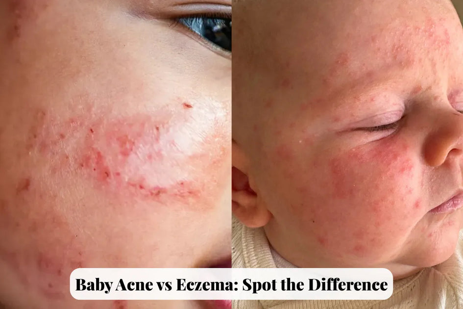 Baby Acne vs Eczema: How to Tell the Difference