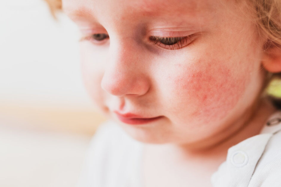 Understanding the Different Types of Eczema