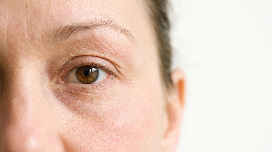 Dermatitis Around the Eyes: Causes and How to Treat It Safely