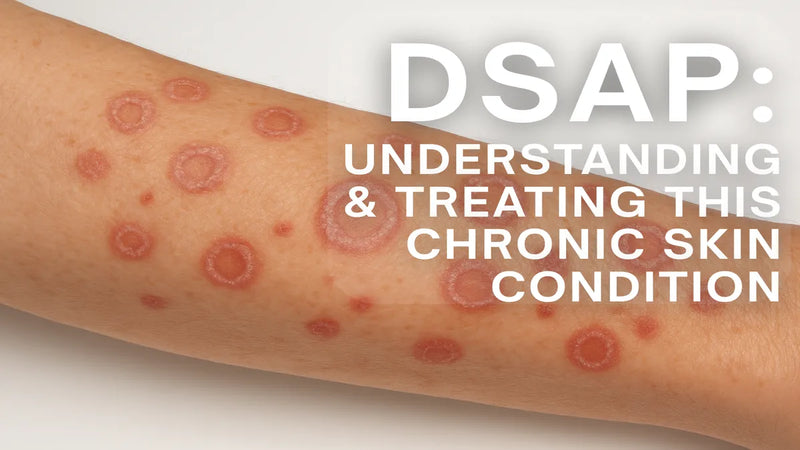 DSAP Treatment Guide: What Works for Disseminated Superficial Actinic Porokeratosis