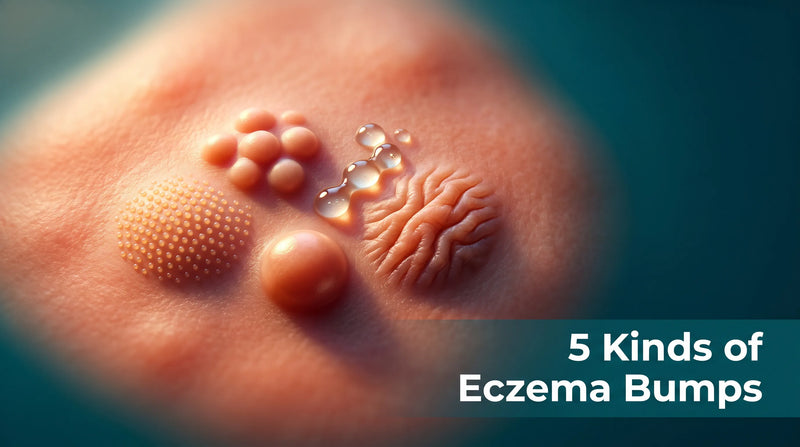 Five distinct raised bump shapes of eczema shown in a bold macro skin surface study