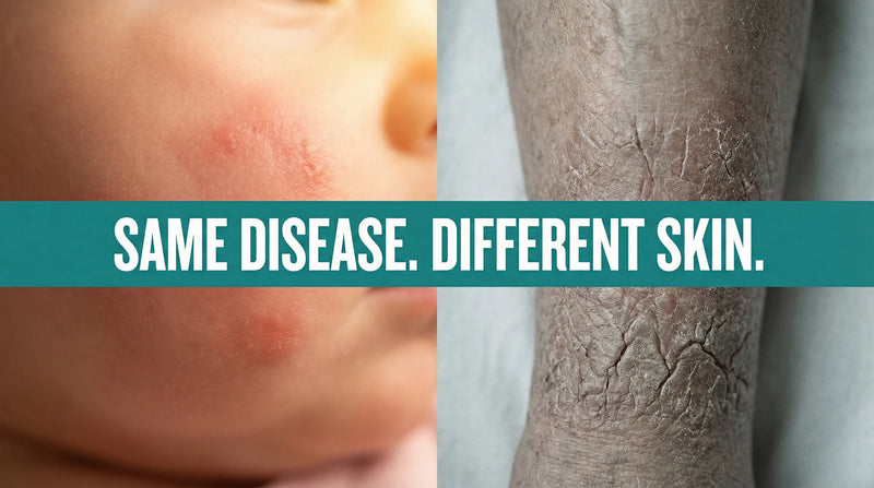 Eczema by age group — how eczema changes from infancy through old age
