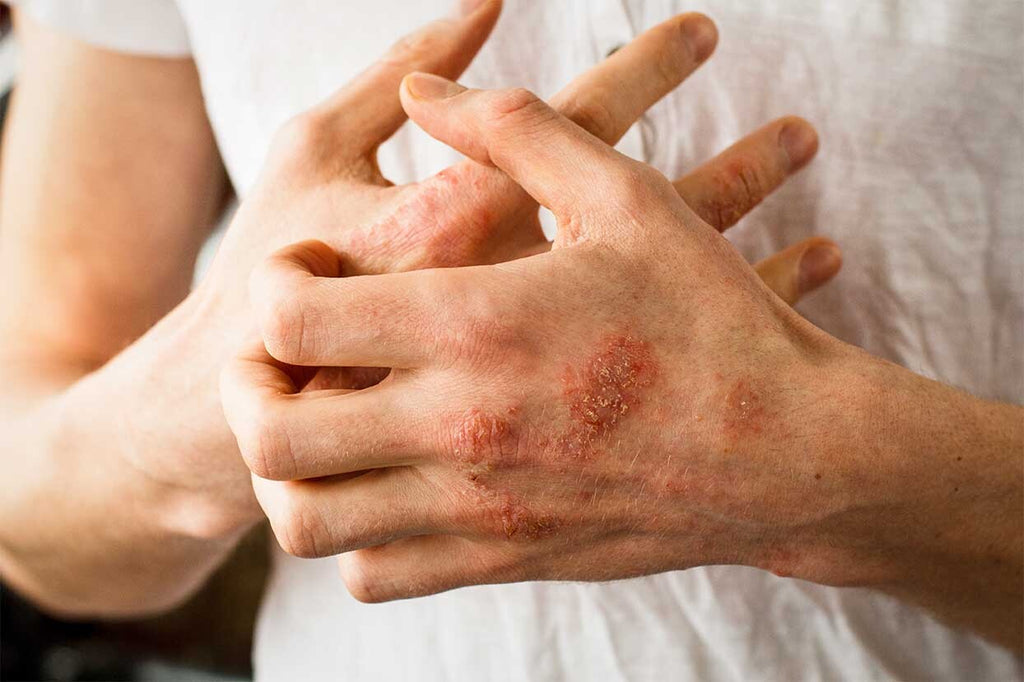 The Interesting (and Weird) Facts You Never Knew About Eczema