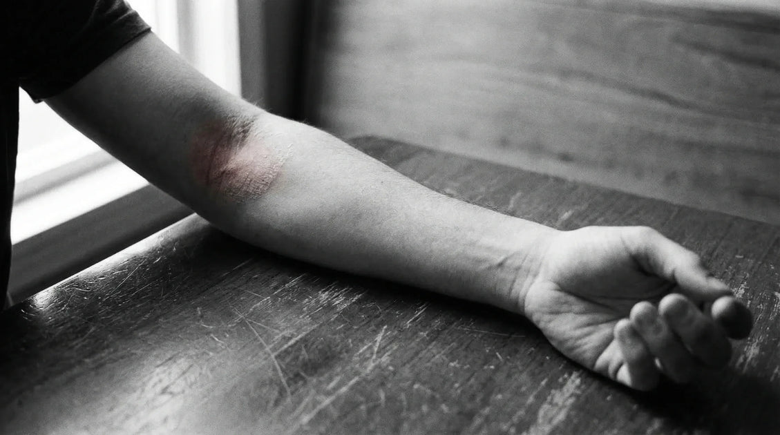 Eczema: Symptoms, Causes, Types, and Treatment Guide