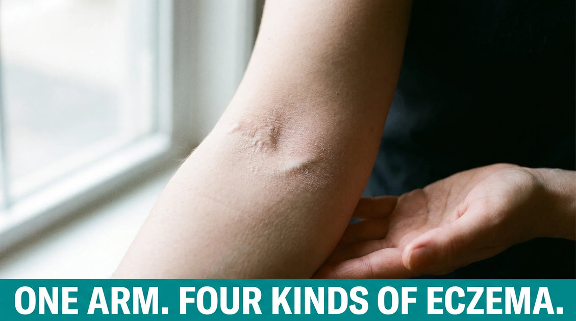 Eczema on the Arm: Zone-by-Zone Causes and Treatment