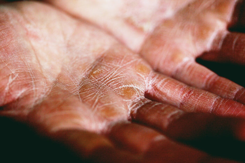 3 Important Facts About Eczema That You Need to Know