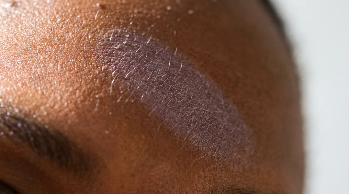 Facial Eczema on Black Skin: How to Recognize It and Treat It Safely
