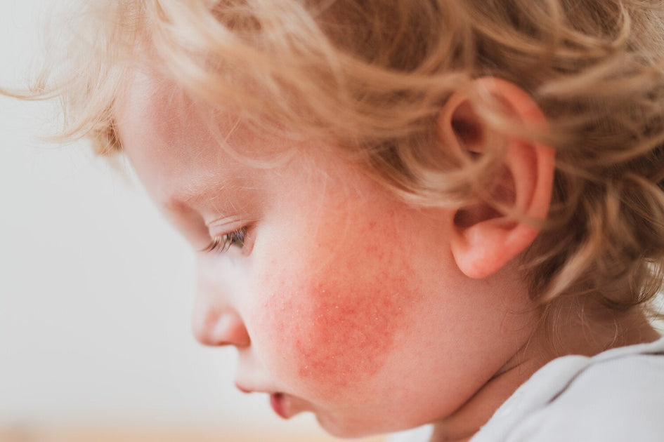 Facial Eczema Care Guide: Symptoms, Causes, and Remedies