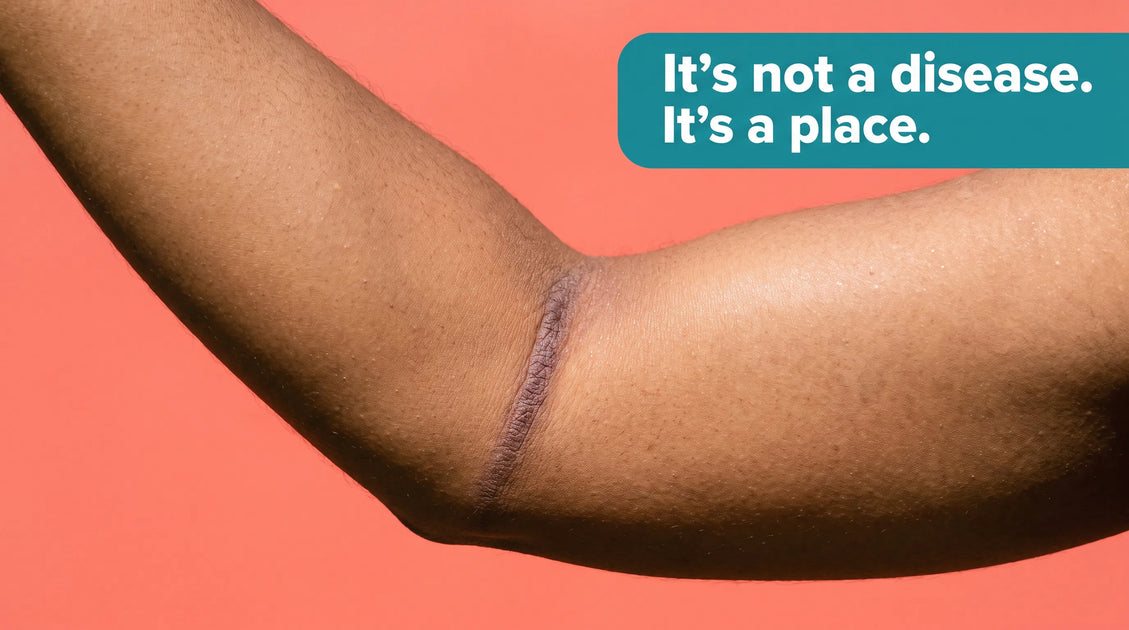 Flexural Eczema: Why Skin Folds Flare, How to Treat Them, and Look-Alikes to Rule Out
