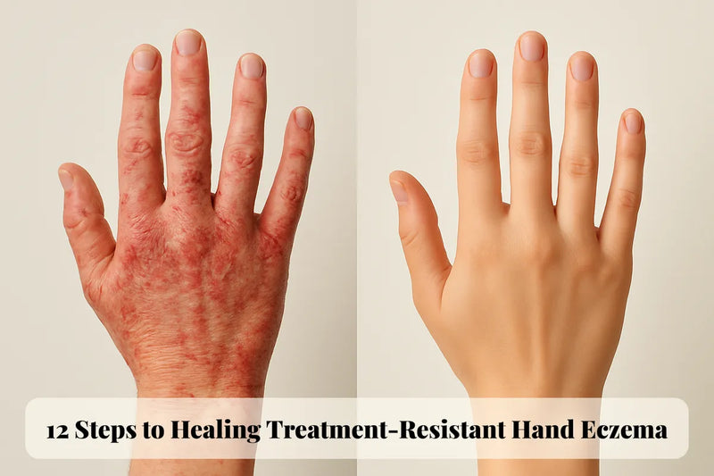 Why Your Hand Eczema Won't Heal: 12 Evidence-Based Steps to Finally Break Free