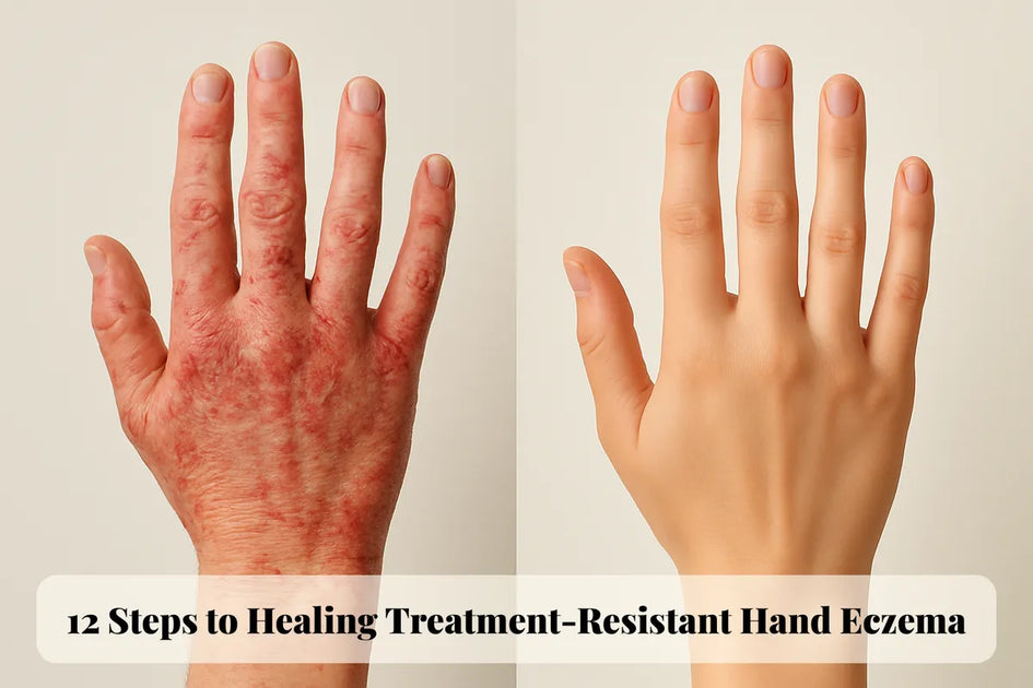 Why Your Hand Eczema Won't Heal: 12 Evidence-Based Steps to Finally Break Free