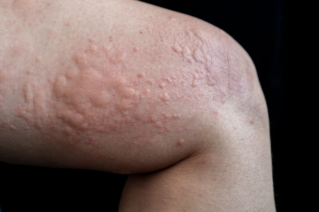 What Are Hives, and How Are They Treated?