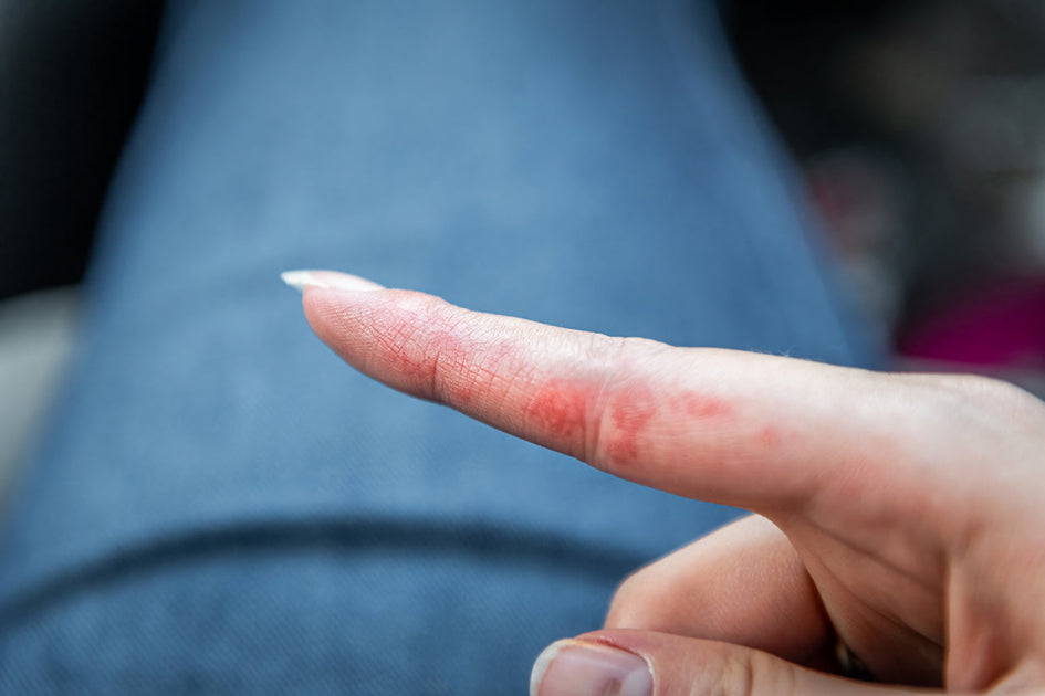 What is Dyshidrotic Eczema, And How Is It Treated?
